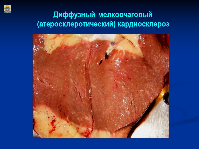 Диффузный мелкоочаговый (атеросклеротический) кардиосклероз